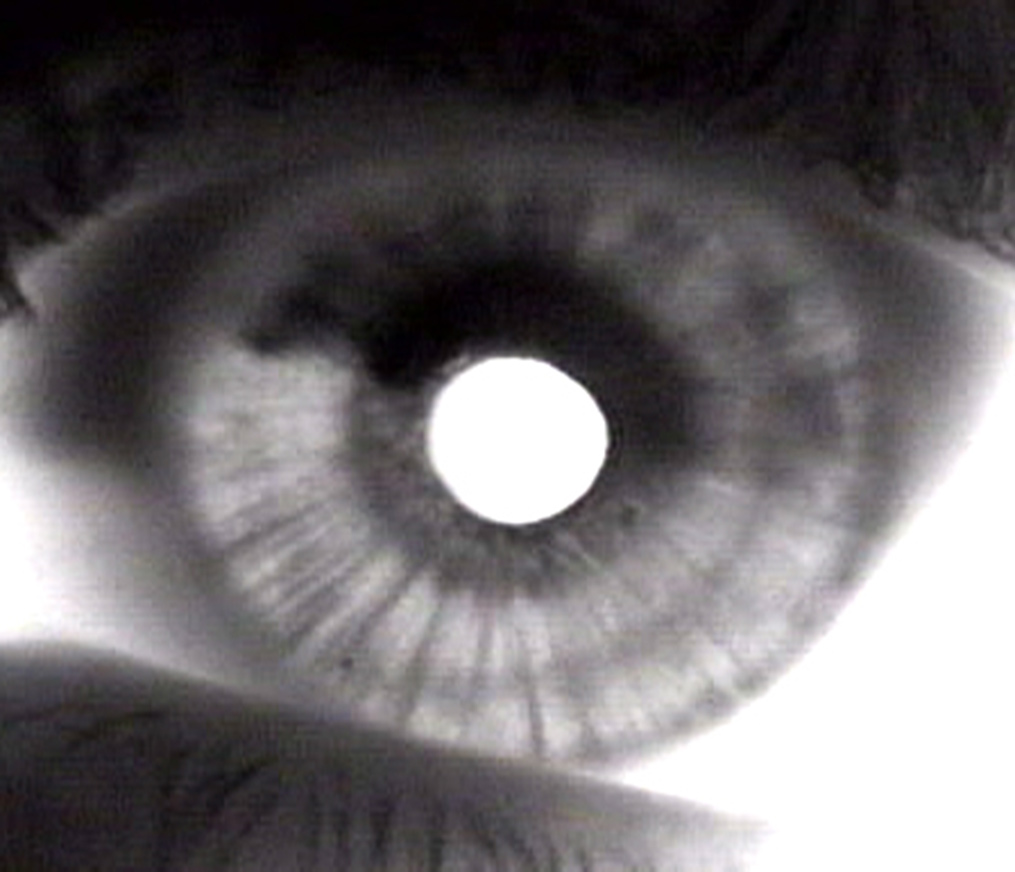 Iris-scleral tumor