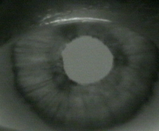 Adies pupil IR