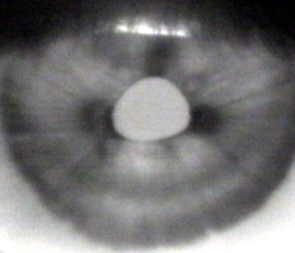 Adies pupil IR
