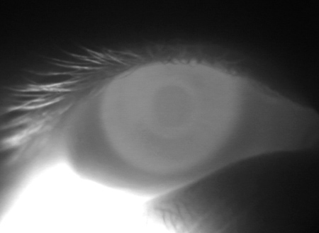 Ocular albinism