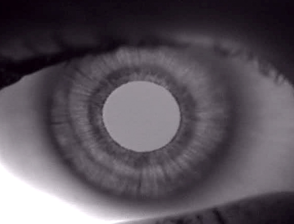 Normal iris