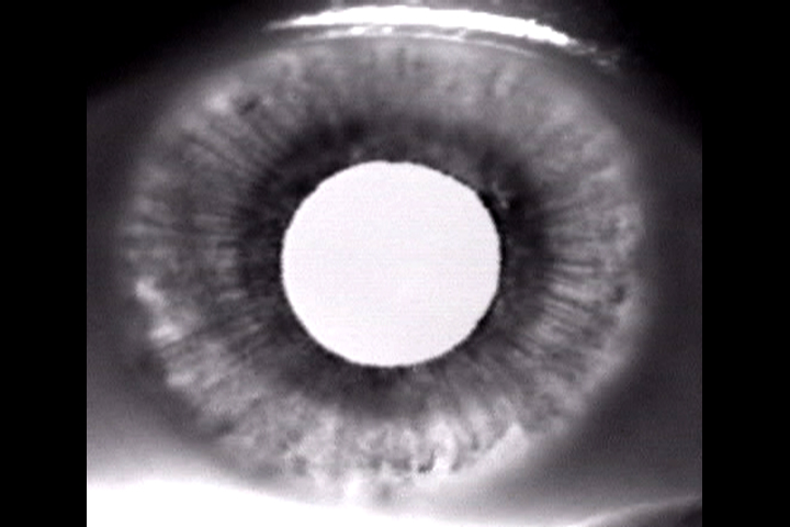 Pigment Dispersion Syndrome