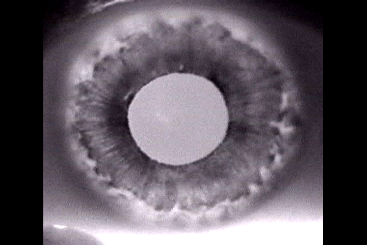 Pigment Dispersion Syndrome