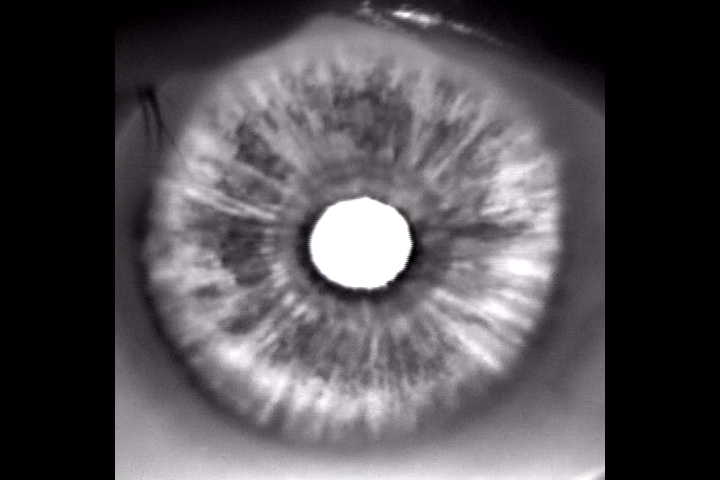 Pigment Dispersion Syndrome