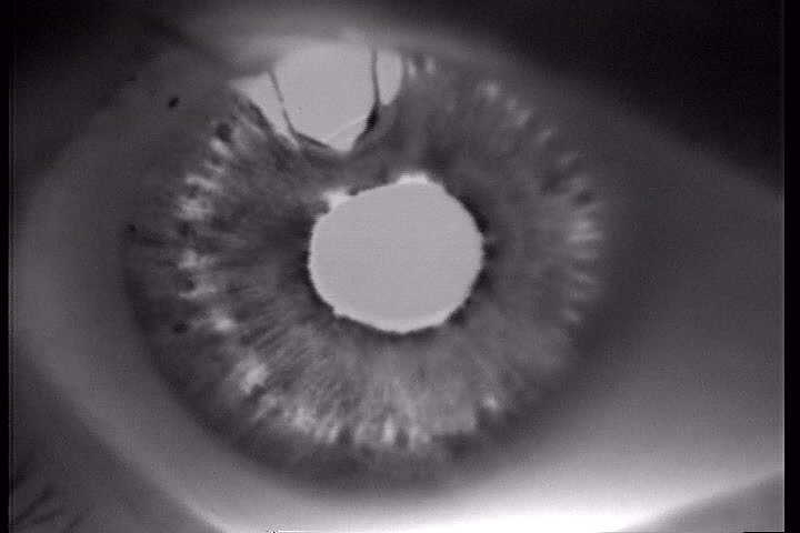 Pigment Dispersion Syndrome