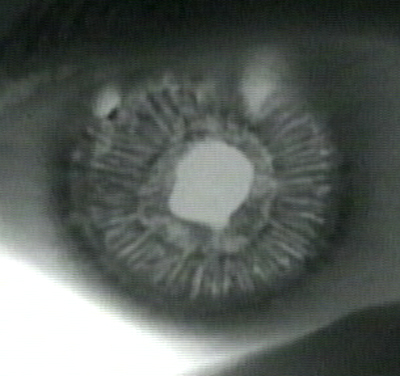 Pseudoexfoliation