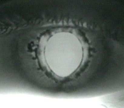Pseudoexfoliation