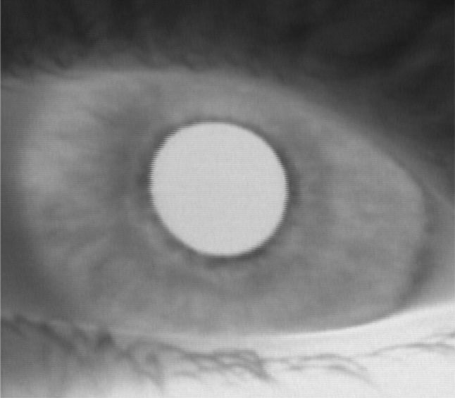Ocular albinism