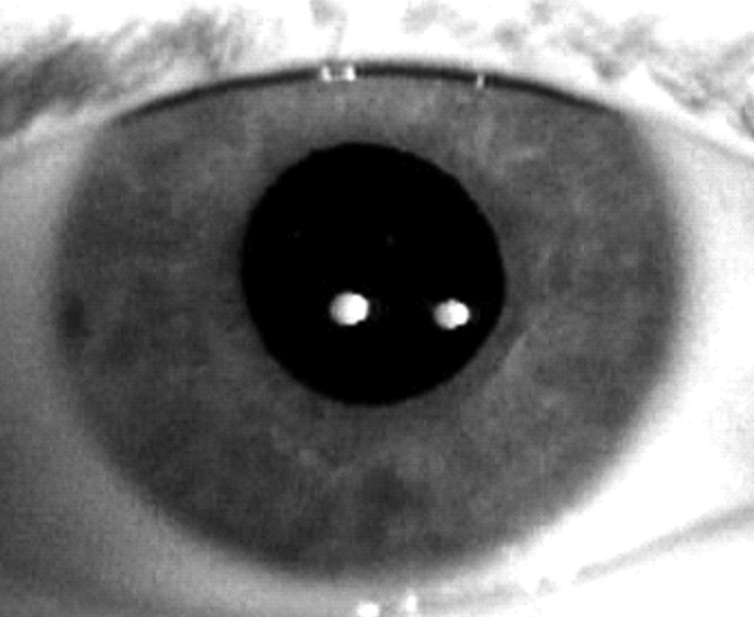 Iris cyst