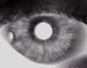 Iris cyst