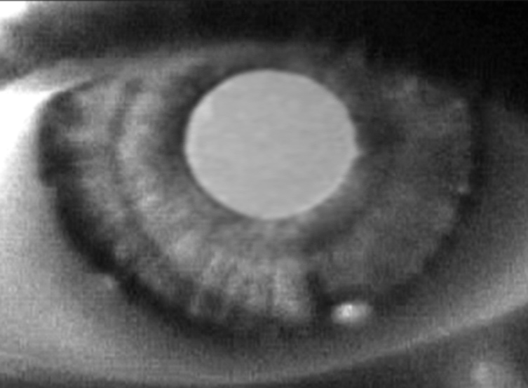 Iris cyst
