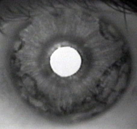 Iris cyst