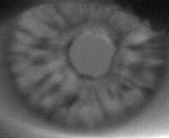 Diabetic eye