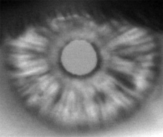 Diabetic eye