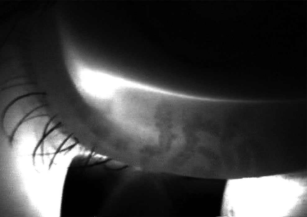 Meibomian gland dropout
