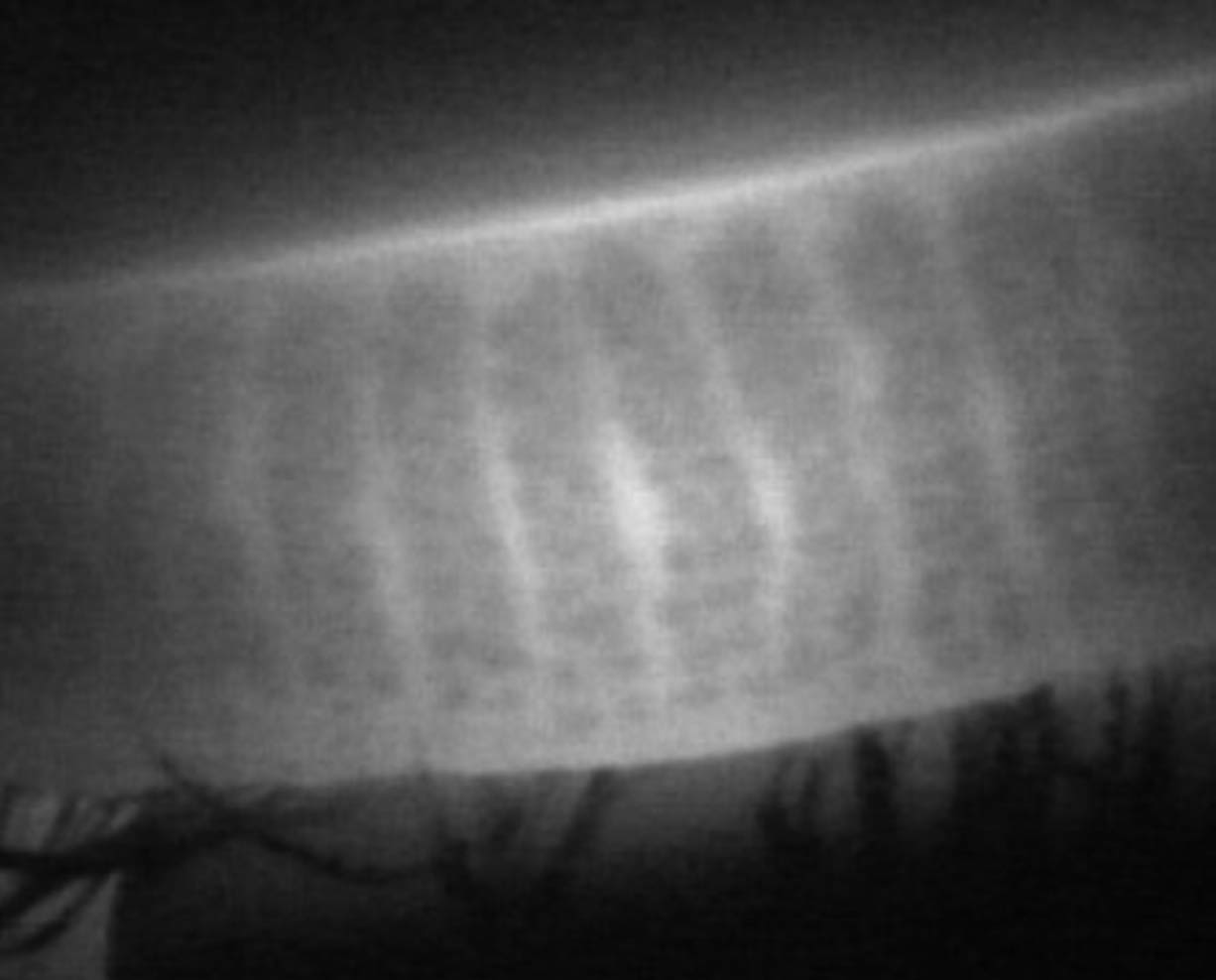 Normal Meibomian Gland