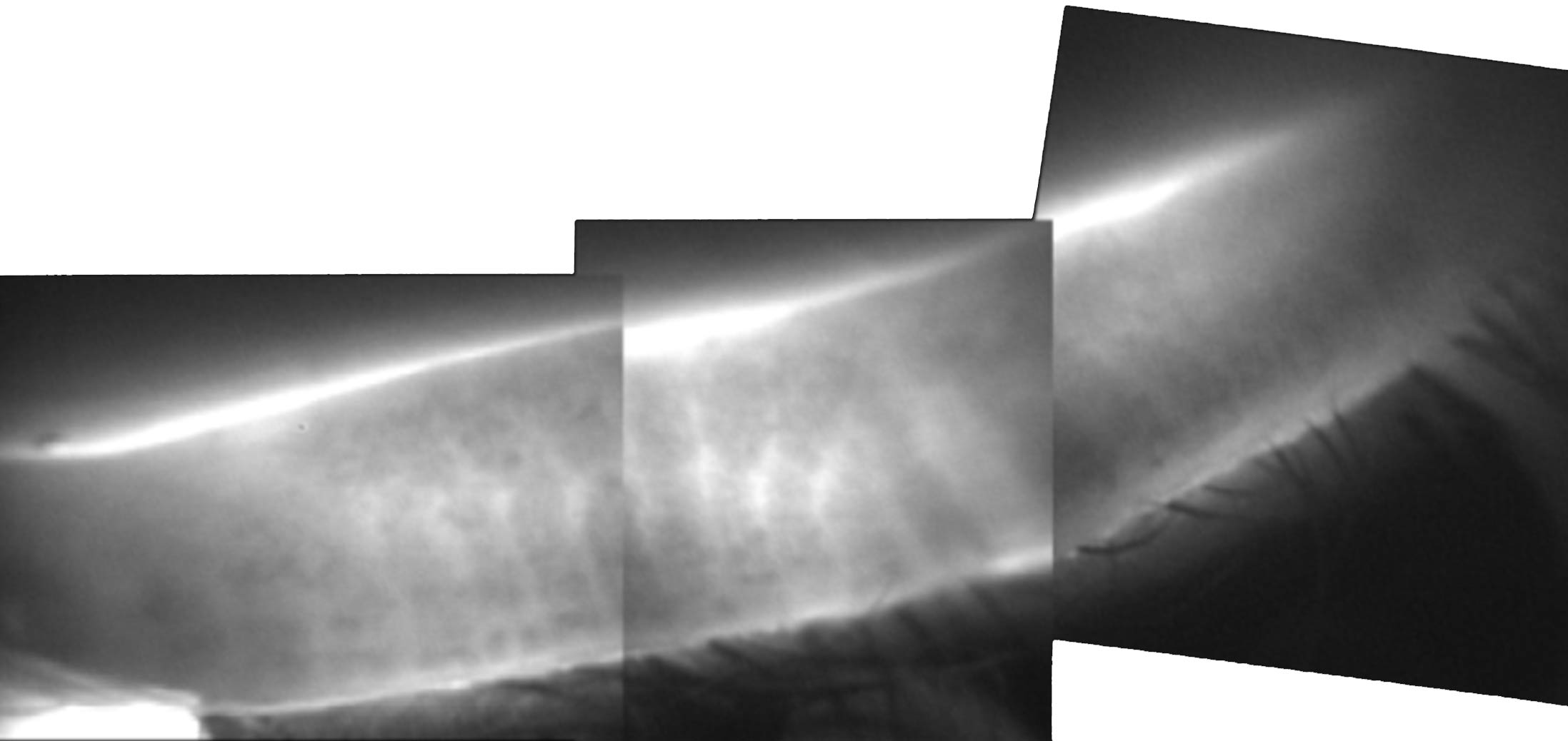 Normal Meibomian Gland