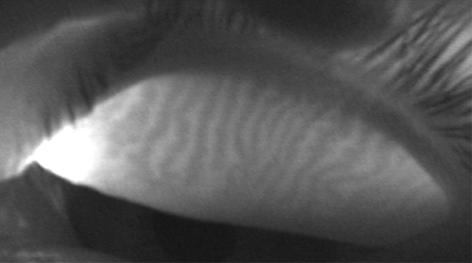 Normal Upper lid meibography