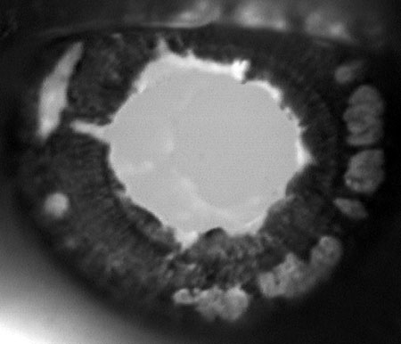 Old with pupil deforming