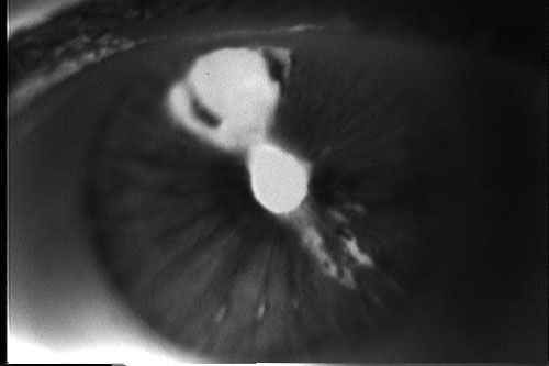 Pupil deforming