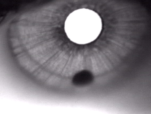 Iris tumor