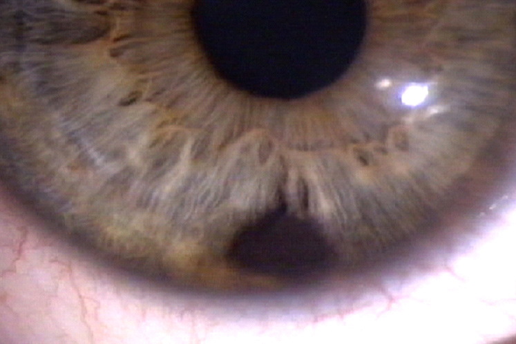 Iris tumors