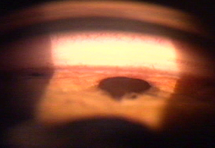 Iris tumors