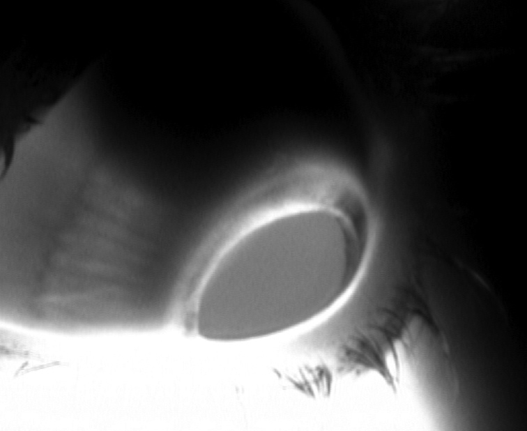 Scleral tumor