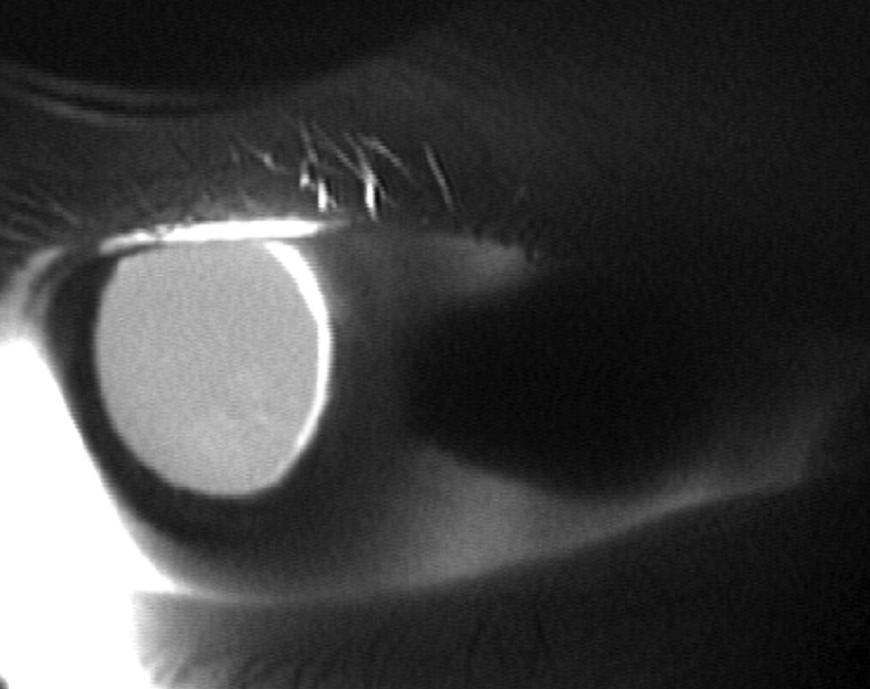 Scleral tumor