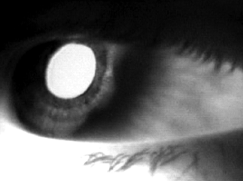 Scleral tumor