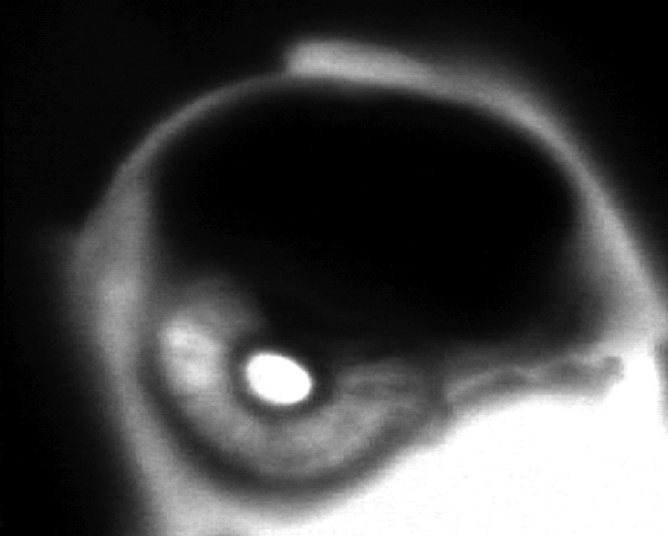 Scleral tumor